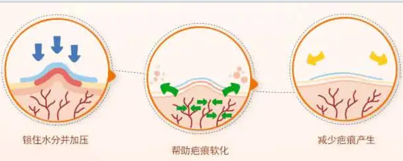 激光割双眼皮效果